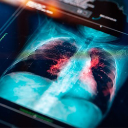 lung cancer scan
